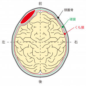 硬膜外血腫
