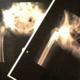 異議申立により後遺障害14級9号が併合9級に変更された大腿骨転子部骨折の事例