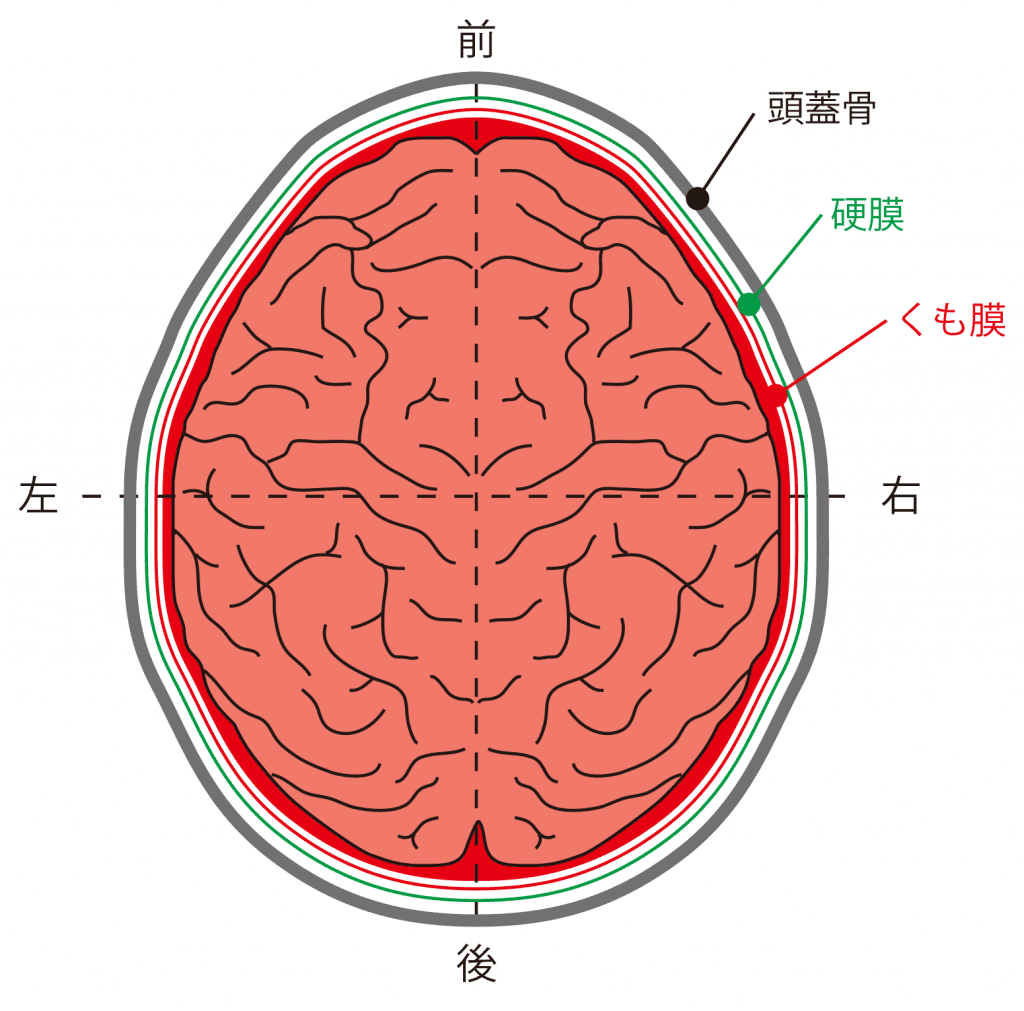 クモ膜下出血、びまん性軸索損傷